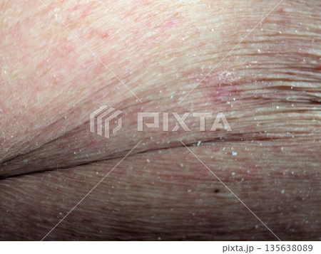 お腹炎症 お腹炎症 135638089
