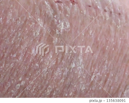 お腹炎症 135638091