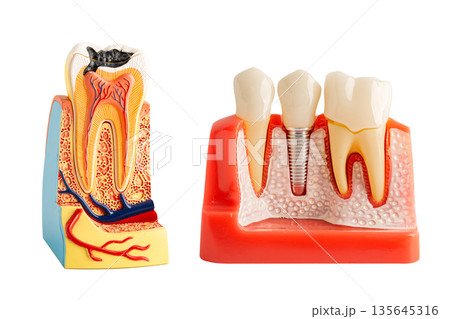 Dental implant, artificial tooth roots into jaw isolated on white background. Dental implant, artificial tooth roots into jaw isolated on white background. 135645316