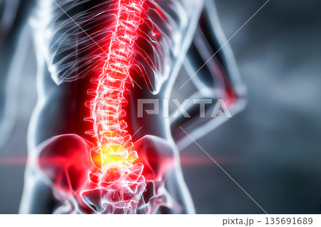 ぎっくり腰・腰痛の原因部位イメージ｜脊椎と神経のビジュアル表現 135691689