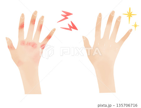 水彩風のハンドケア素材 しもやけ改善前後のビフォーアフター挿絵 135706716