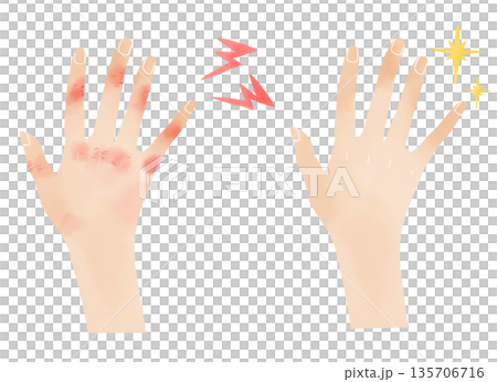 Watercolor hand care material - Before and after illustrations of chilblains 135706716