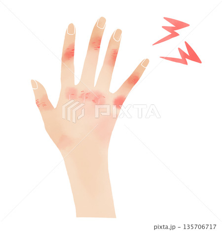 水彩風の手のイラスト 赤く腫れたしもやけやあかぎれの症状素材 135706717