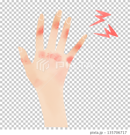 水彩風の手のイラスト 赤く腫れたしもやけやあかぎれの症状素材 135706717