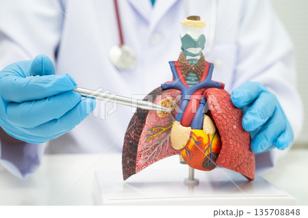 Pneumonia, lung cancer, Asian doctor holding human model. 135708848