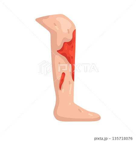 Illustration of Leg Injury 135718076