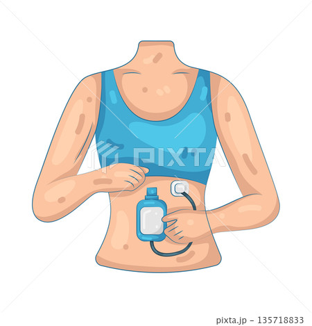 Illustration of woman using an insulin pump Illustration of woman using an insulin pump 135718833