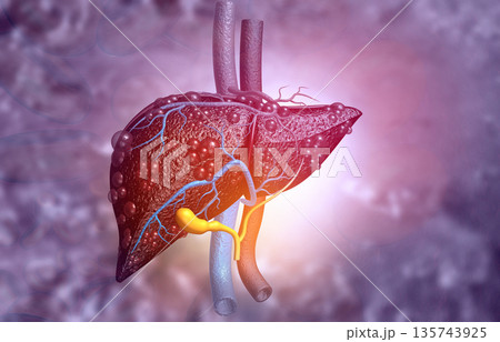 Diseased liver Diseased liver 135743925