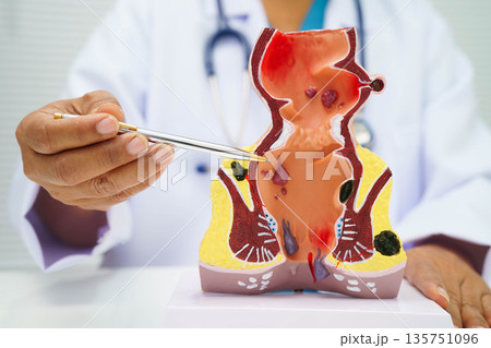 Asian doctor with rectum and hemorrhoid human anatomy model at hospital, inflamed vascular structure. 135751096
