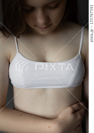 girl in white top with scar from heart surgery. Concept of medicine, health, beauty, psychology. girl in white top with scar from heart surgery. Concept of medicine, health, beauty, psychology. 135767591