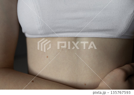 girl in white top with scar on her body from surgery Concept of medicine, health, beauty, psychology girl in white top with scar on her body from surgery Concept of medicine, health, beauty, psychology 135767593