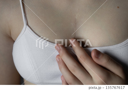 girl in white top with scar from heart surgery. Concept of medicine, health, beauty, psychology. girl in white top with scar from heart surgery. Concept of medicine, health, beauty, psychology. 135767617