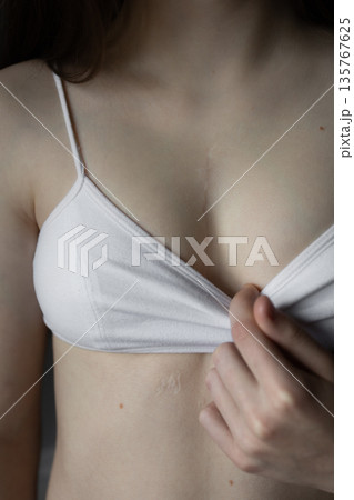 girl in white top with scar from heart surgery. Concept of medicine, health, beauty, psychology. 135767625