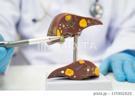 Cirrhosis, Liver cancer, fatty liver, Asian doctor with liver human model. Cirrhosis, Liver cancer, fatty liver, Asian doctor with liver human model. 135802828