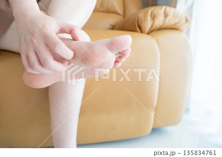 Woman scratching itchy feet that are peeling and cracked. Cause of itchy include athlete's foot (fungal infection), dermatitis (eczema), dry skin, dehydration or sweaty feet. Health care concept. 135834761