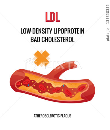 Type of cholesterol in human blood vessels. Narrowed artery for explanation diseases. Low-Density Lipoprotein LDL . Vector illustration 135838336