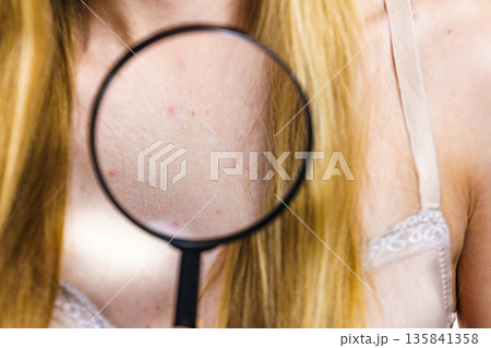 Woman with skin problem acne on neckline Woman with skin problem acne on neckline 135841358