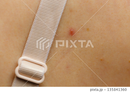 Closeup skin with acne moles and red spots. 135841360