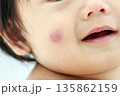 子どもの虫刺され 135862159