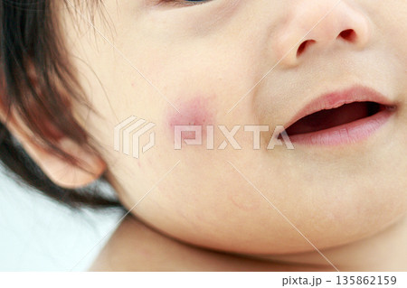 子どもの虫刺され 135862159