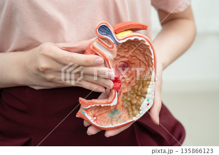 Stomach disease, Asian woman holding anatomy model for study diagnosis and treatment in hospital. 135866123
