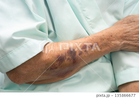 Ecchymosis, elderly bleeding on her arm after taking aspirin. Ecchymosis, elderly bleeding on her arm after taking aspirin. 135866677