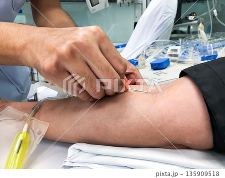 Blood platelet donation, a male nurse inserts a needle into donor arm to draw blood at a hospital. 135909518