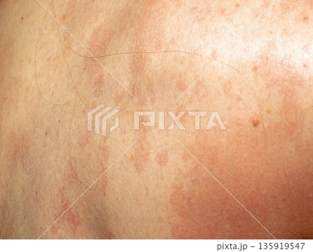 Psoriasis on skin Psoriasis on skin 135919547