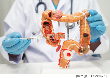 Colorectal cancer, doctor holding intestine colon human model. 135946745