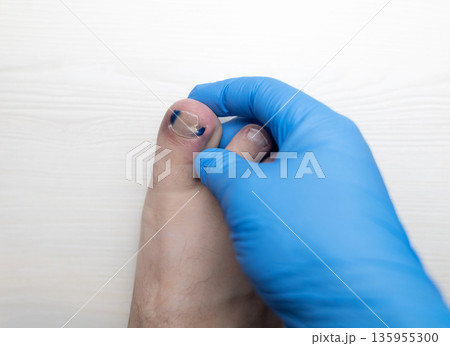 Medical pedicure treatment showing toe nail tamponade to prevent ingrown toenail. Podiatry procedure with cotton packing, antiseptic care and nail correction. 135955300