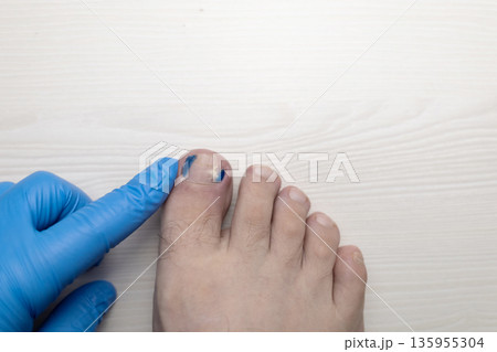 Medical pedicure treatment showing toe nail tamponade to prevent ingrown toenail. Podiatry procedure with cotton packing, antiseptic care and nail correction. 135955304
