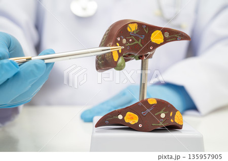 Cirrhosis, Liver cancer, fatty liver, Asian doctor with liver human model. Cirrhosis, Liver cancer, fatty liver, Asian doctor with liver human model. 135957905