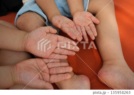 Hand foot and mouth disease (HFMD) rash and blisters on a child's hand and leg. 135958263