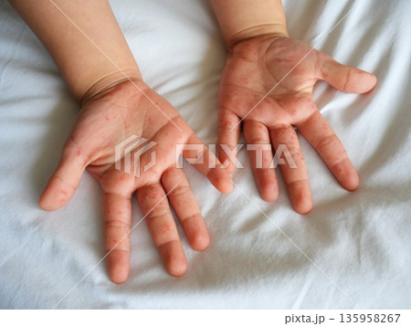 Hand foot and mouth disease (HFMD) rash and blisters on a child's hand and leg. Hand foot and mouth disease (HFMD) rash and blisters on a child's hand and leg. 135958267