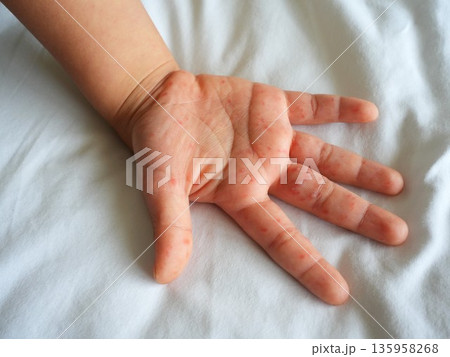 Hand foot and mouth disease (HFMD) rash and blisters on a child's hand and leg. Hand foot and mouth disease (HFMD) rash and blisters on a child's hand and leg. 135958268