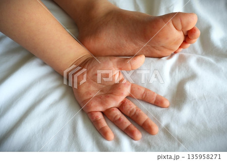 Hand foot and mouth disease (HFMD) rash and blisters on a child's hand and leg. Hand foot and mouth disease (HFMD) rash and blisters on a child's hand and leg. 135958271
