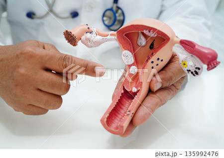 Uterus, doctor holding human anatomy model for study diagnosis and treatment in hospital. Uterus, doctor holding human anatomy model for study diagnosis and treatment in hospital. 135992476
