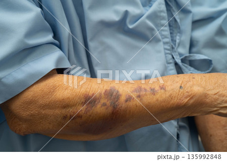 Ecchymosis, elderly bleeding on her arm after taking aspirin. Ecchymosis, elderly bleeding on her arm after taking aspirin. 135992848