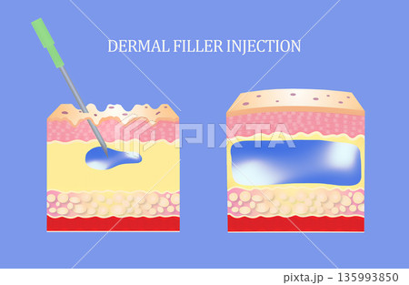Injectable cosmetic filler or dermal fillers. Before and after. Lifting concept 135993850