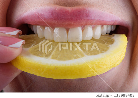 Close up of female teeth biting lemon slice showing ceramic veneers and natural dental care concept 135999405