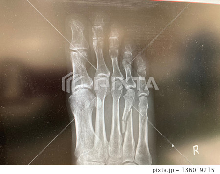 骨折の記念写真 136019215