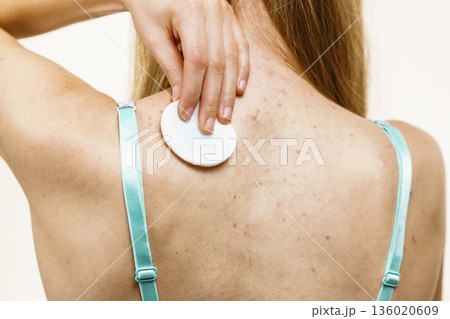Woman acne on back cleaning skin with cotton 136020609