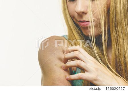 Woman scratching her itchy arm. Skin allergy. 136020627