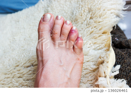 Bedroom scene with a injured bare foot a broken or sprained bruised reddened toe phalanges resting on a bed covered with a sheepskin rug 136026461