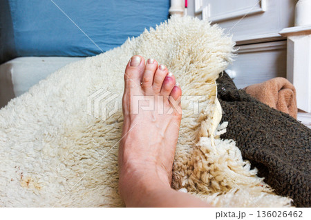 Bedroom scene with a injured bare foot a broken or sprained bruised reddened toe phalanges resting on a bed covered with a sheepskin rug 136026462