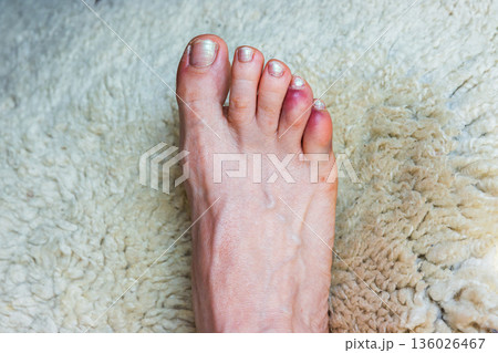 Close up of a bare foot with a broken or sprained bruised reddened fourth and fifth toes distal and middle phalange 136026467