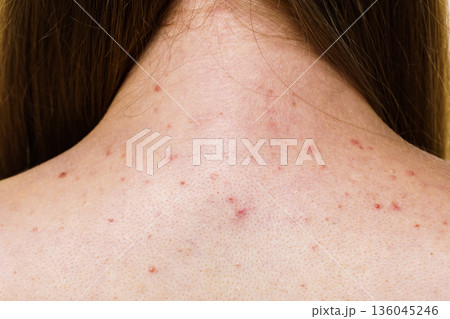 Woman with skin problem acne on back Woman with skin problem acne on back 136045246