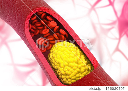 Clogged Arterie 136080305