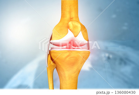 knee joint arthritis knee joint arthritis 136080430