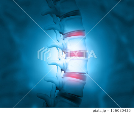Disc problem of human spine Disc problem of human spine 136080436